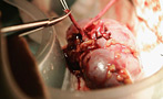 He Gave His Wife a Kidney. She Divorced Him. What Does She Owe Him?