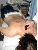 Two days after cupping, I undergo a "scraping" treatment to increase body 
temperature. Click image to expand.
