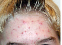 Acne of a 14 year old boy. Click image to expand.