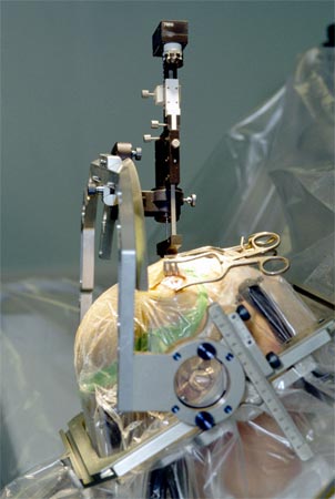 Deep brain stimulation might help severely depressed patients.