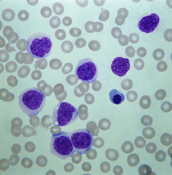 Leukaemic cells.