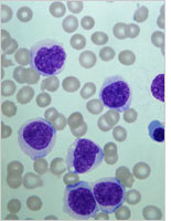 Leukaemic cells. Click image to expand