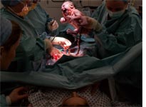 Cesarean section birth