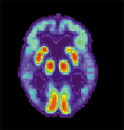 PET scan of a brain with Alzheimer's disease.