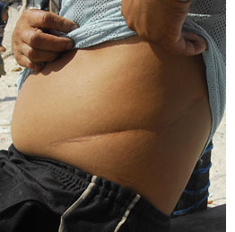 (Photo of Joey Rosco showing his kidney scar by JES AZNAR/AFP/Getty Images)