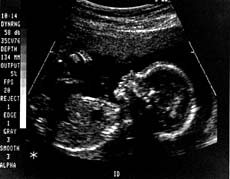 Ultrasound scan of fetus at 20 weeks
